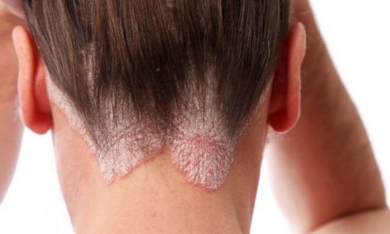 Psoriasis afecta a 2.5 millones de personas en México